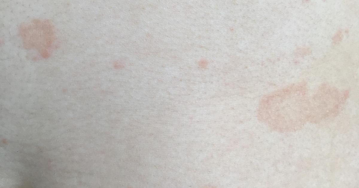 Pityriasis rosea Gibert | Dermaweb